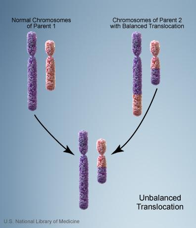 An unbalanced translocation occurs when a child inherits a chromosome with extra