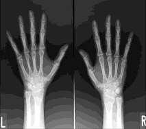 We had obtained informed consent from all subjects. Figure 1 shows the hand X-ray image which have 2010 1572 pixels.