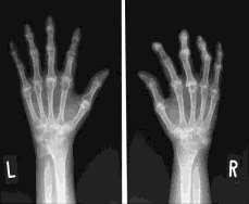 The X-ray image is divided to left and right side, and the right side is inverted horizontally in order to increase the number of subjects. (a) Mild R.A Patient (b) Severe R.A Patient FIGURE 1.