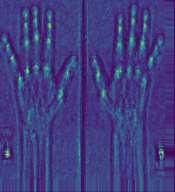 (a) Mild R.A Patient -1.0 (b) Severe R.A Patient 3.1 Finger joint detection FIGURE 3.