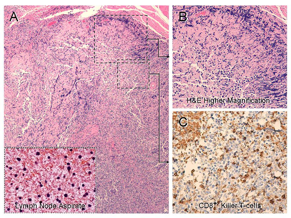 Histologic Evidence of Long Lasting Anti-tumor Immunity in a Patient with Metastatic Pancreas Cancer Note: An indicator cervical lymph node was resected 8 weeks and one year after treatment