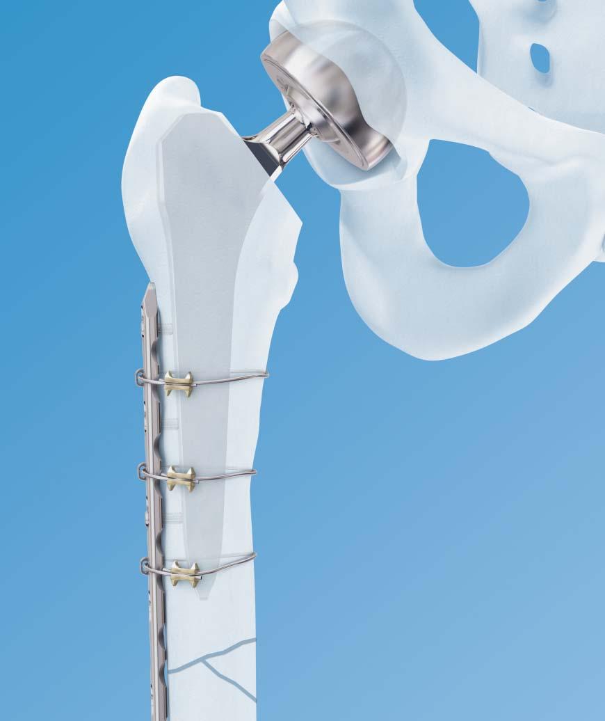 LCP Periprosthetic System. Part of the Synthes locking compression plate (LCP) system. 4.