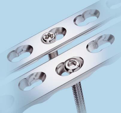 This provides the flexibility of conventional screw fixation (such as axial compression) or fixed-angle constructs, and gives the surgeon the ability to handle diverse and difficult fractures with