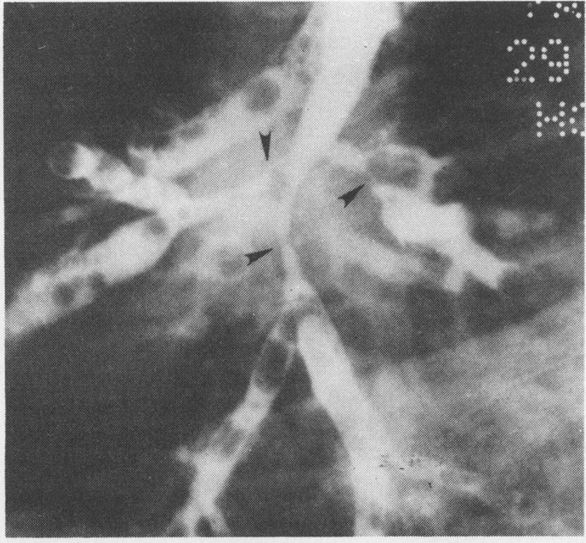 Her chest radiograph showed right paratracheal lymphadenopathy and loss of volume of the right lung as evidenced by mediastinal shift.