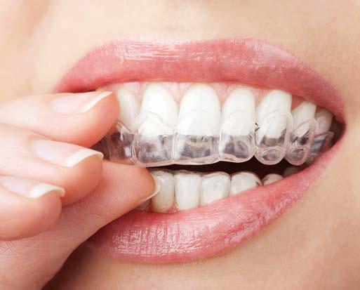 WHITEN YOUR TEETH BY YOUR DENTAL PROFESSIONAL Having your teeth whitened professionally is the best way to get the million-dollar smile that you are looking for. Trays and gel.