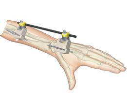 The Peri-Articular Clamp is designed to