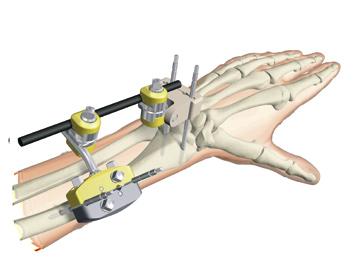 inserted parallel to the radial joint.