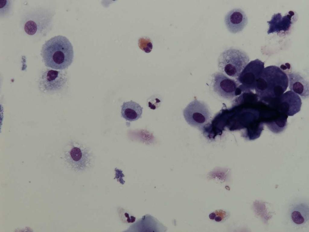 A B Figure S1: Cytological analysis of sputum samples from the study.