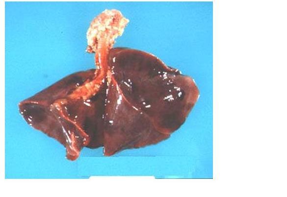 MORPGHOLOGY The lungs of a neonate with RDS are normal in size, but are solid, airless, and reddish purple, similar to the color of the liver.