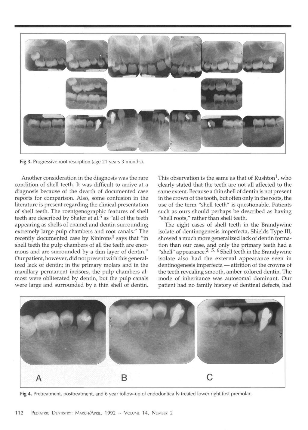 Fig 3. Progressive root resorption (age 21 years 3 months). Another consideration in the diagnosis was the rare condition of shell teeth.