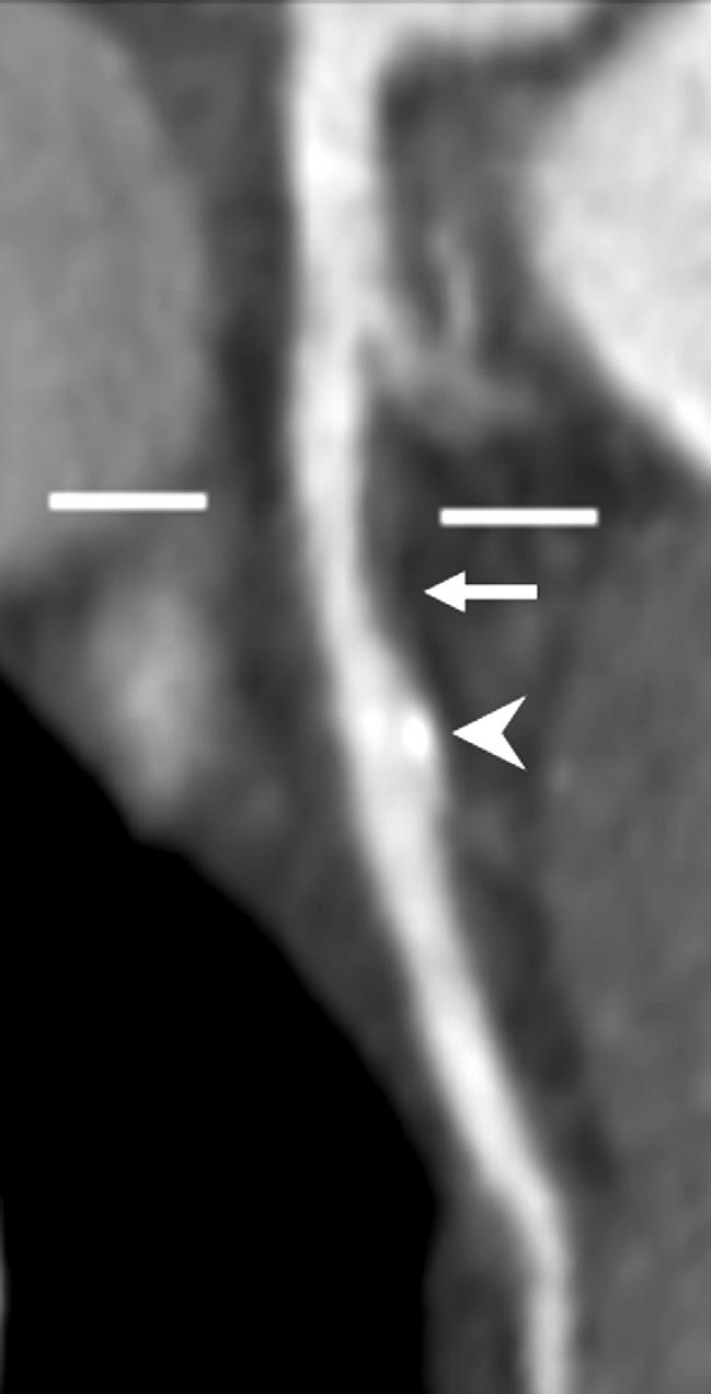 10 Figure 5. Mild to moderate stenosis of the proximal left anterior descending artery on CCTA, caused by a soft (non-calcified) plaque (arrow).