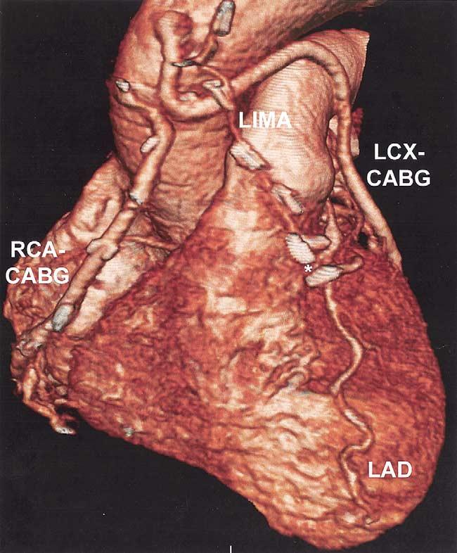 Ann Thorac Surg DEWEY ET AL 2004;77:800 4 MSCT OF CORONARY ARTERY BYPASS GRAFTS Abbreviations and Acronyms CABG coronary artery bypass graft CT computed tomography GCV great cardiac vein LAD left