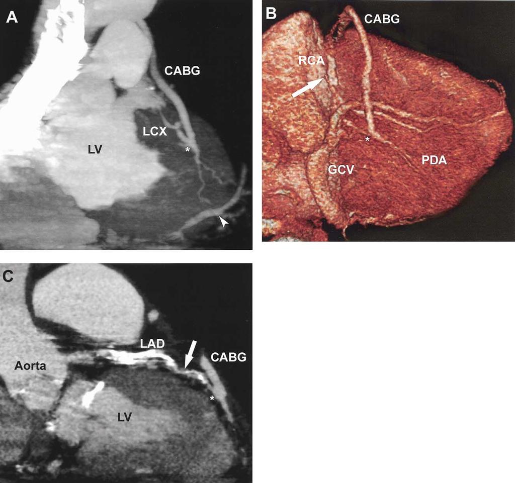 802 DEWEY ET AL Ann Thorac Surg MSCT OF CORONARY ARTERY BYPASS GRAFTS 2004;77:800 4 Fig 2. Representative examples of venous CABGs including the distal anastomoses.