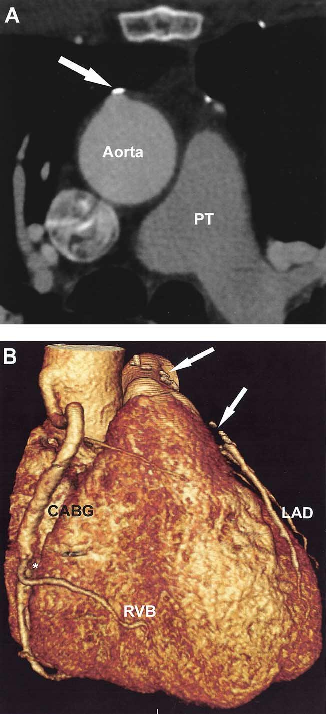 Ann Thorac Surg DEWEY ET AL 2004;77:800 4 MSCT OF CORONARY ARTERY BYPASS GRAFTS 803 conventional angiography.