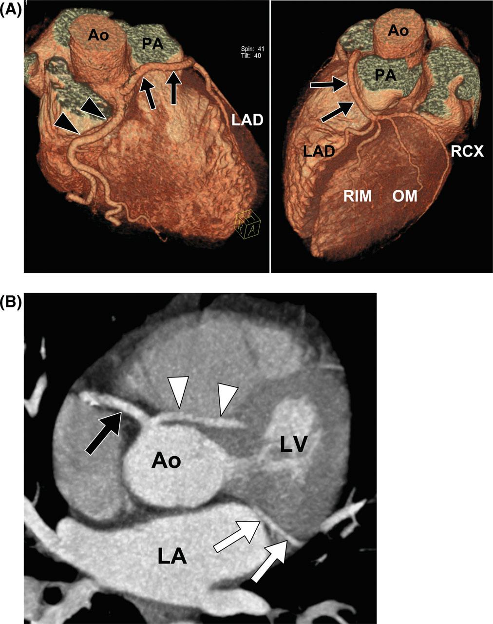 540 S. Schroeder et al Figure 5 Imaging of coronary anomalies by multi-detector row computed tomography.