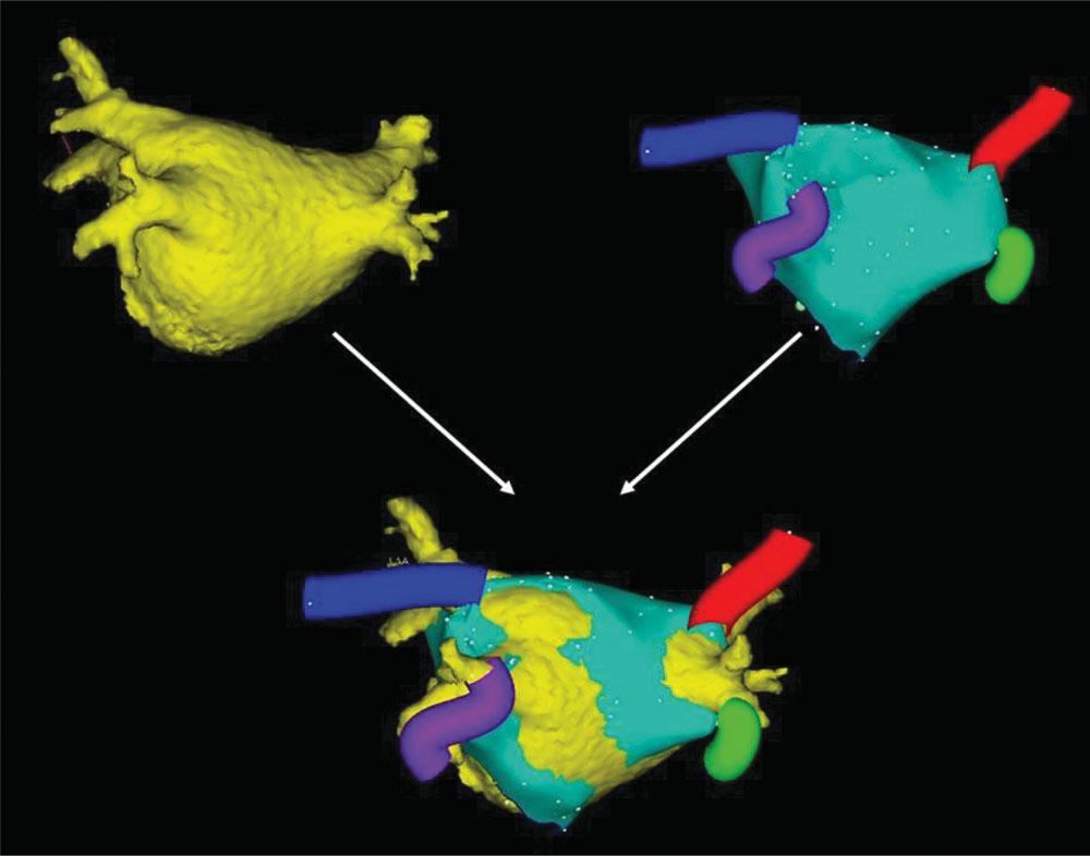 546 S. Schroeder et al Figure 11 Fusion imaging in electrophysiology using multi-detector row computed tomography and electro-anatomical mapping.