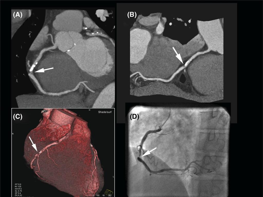 Cardiac computed tomography 533 such as nuclear perfusion scans (with a typical dose of 8 25 msv 38,39 ), all possible measures should be taken to keep the dose as low as possible, and considerations