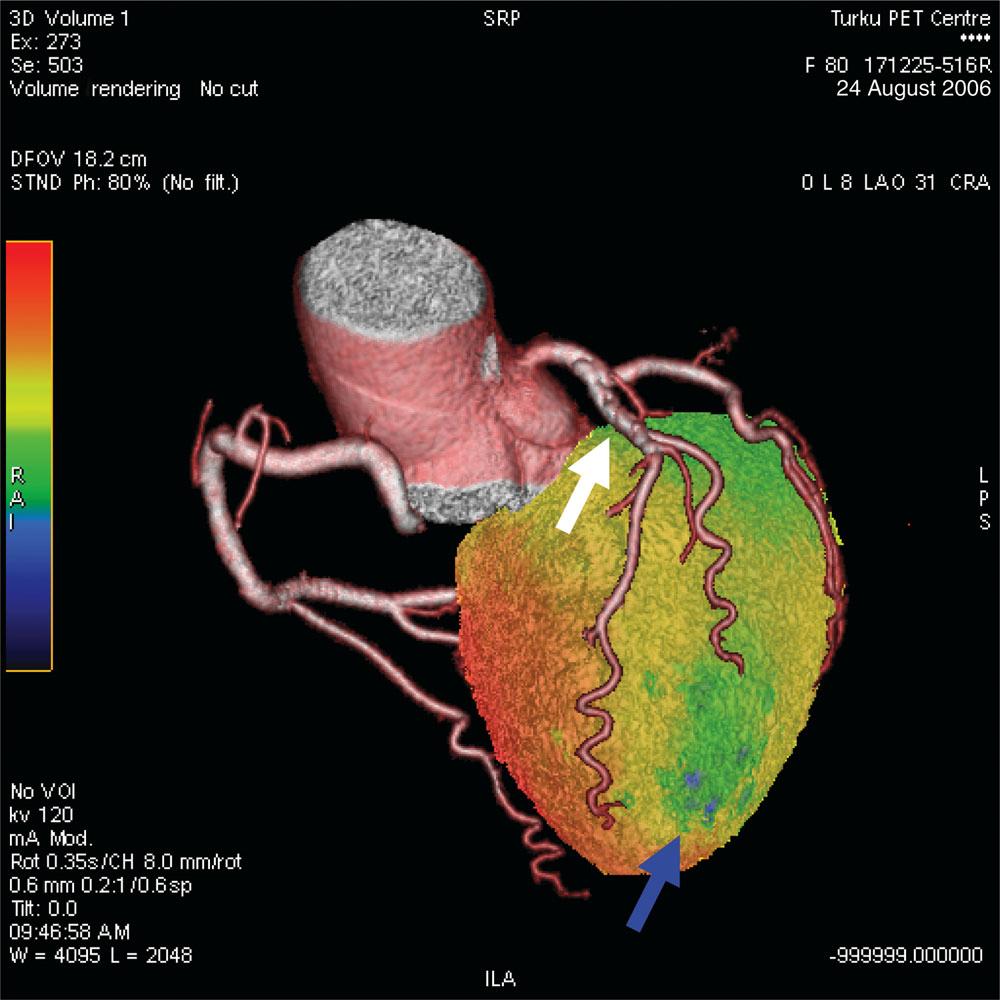 Cardiac computed tomography 535 Lesion severity and functional relevance The limited temporal and spatial resolution of CT may create difficulties in accurately assessing the severity of coronary