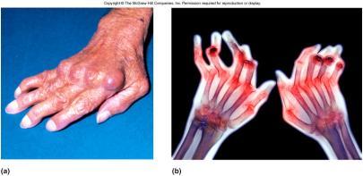 Rheumatoid Arthritis (RA) Result of autoimmune attack on