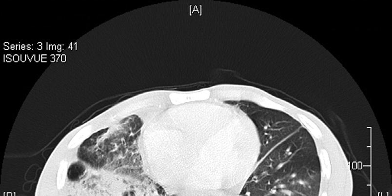 Chest CT Scan Showing Extensive Consolidation and Cystic