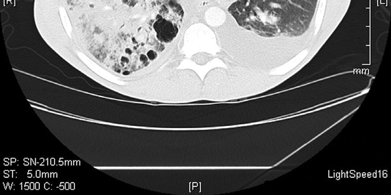 Left Pleural Effusion With Compressive Atelectasis and Early