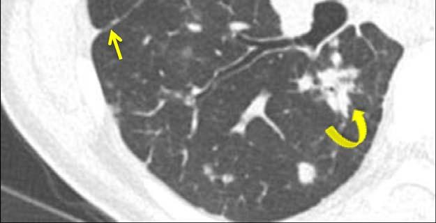 lung predominant, often peribronchovascular in distribution May progress