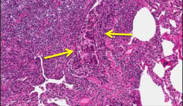 (mucosa-associated lymphoid tissue) lymphoma or MALToma, a subset of B-cell non-hodgkin lymphoma
