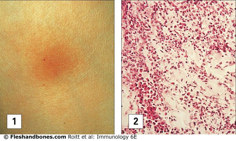 Type IV Hypersensitivity Tuberculin reaction Tuberculin Reaction Histology: Infiltrate of leukocytes Positive PPD test: >10 mm induration (PPD=purified protein derivative) Local responses to antigen