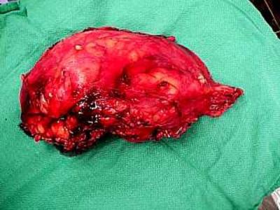 10: Removal of the intracardiac tumor