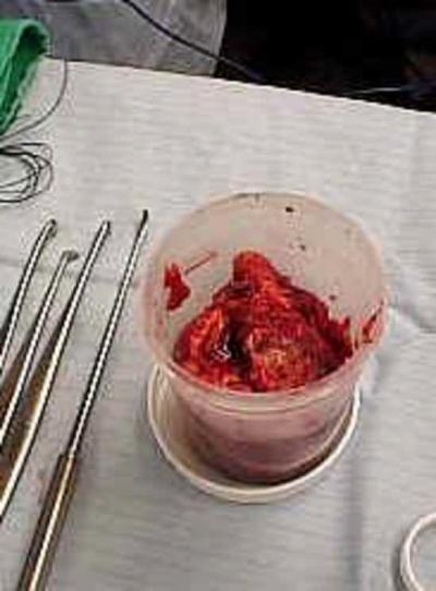 removed from IVC Figure 12