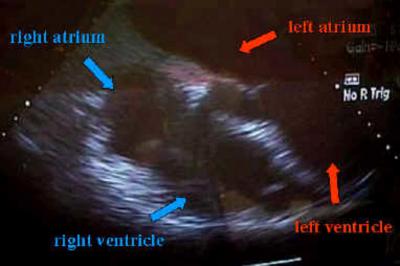 Figure 15 Image 15: Transesophageal echocardiography with no tumor mass left in right atrium iv and central venous catheter. Make sure to have an adequate supply on blood products available. 3.