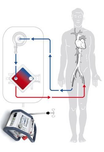Emergency surgical treatment Transportable extracorporeal assist systems with percutaneous femoral