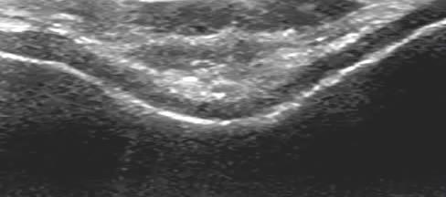 Suprapatellar transverse scan m.f. Sonographic signs of cartilaginous changes Normal 1.
