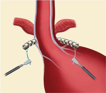LINX Reflux Management System 10 LINX is placed around the esophagus LINX in place with the ends connected What happens after the treatment?