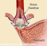 Stomach juices reflux into the esophagus and may injure the esophagus and cause symptoms of heartburn or regurgitation.