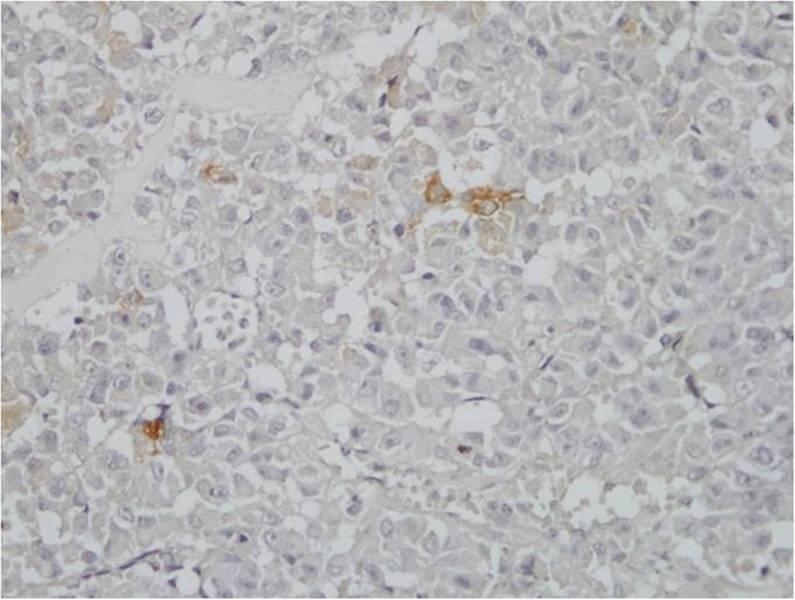 mitotic figures seen (H&E, x40). (b) Immunohistochemical staining showing negative reaction for TSH (x40). Figure 4.