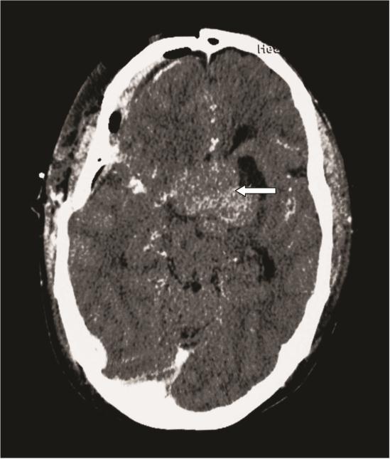 34cm, with similar degree of mass effect and probable invasion to the left cavernous sinus (3b, arrow) Discussion Figure 3.