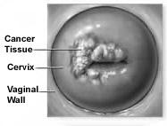 HPV genome found in 99.7% of cervical cancers HPV types 16 and 18 induce 58% and 12% of cervical cancer.