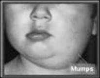 Mumps Mumps Epidemiology Mumps Sequelae Mumps Epidemic 2006