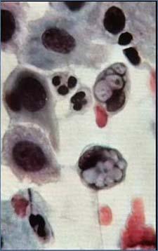 cervicitis Chlamydia