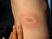 Symptoms Three to 30 days after a blacklegged tick bite, look for: A Distinctive Rash Fever Chills Headache Muscle and joint pain Fatigue Irregular