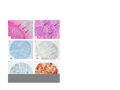 Breast Cancer Pathology Excess of medullary histopathology, Higher histologic grade, More likely to be ER ve and PR -ve, HER2/neu overexpression; BRCA1-related tumors triple negative breast cancer