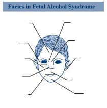 Microcephaly Short palpebral fissures Flattened midface Epicanthal folds Flat nasal bridge