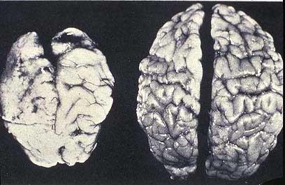 Brain Damage from Prenatal