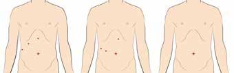 Cholecystectomy through the belly button can be done using traditional single incision laparoscopy or da Vinci Single-Site Surgery.