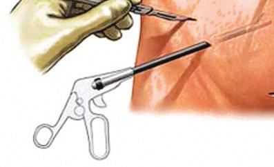 this lets your surgeon have a clear view of the gallbladder through the laparoscope. A small light and camera on the scope send images to a video monitor.