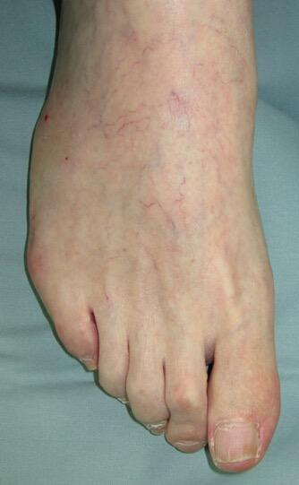 Bunion. Midterm results of 21 patients.