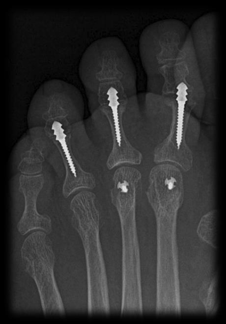 30 Patients with MTP Contracture Level IV Evidence Weil Osteotomy n=25 22 month F/U Transfer lesions=zero