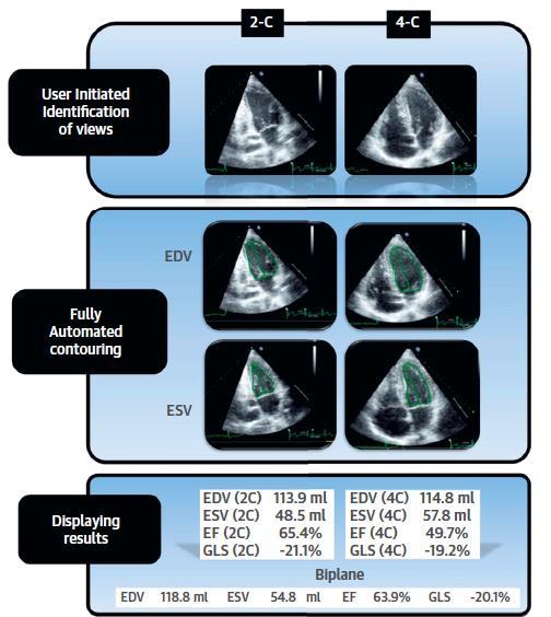 Fully Automated Versus Standard Tracking of Left Ventricular Ejection Fraction and