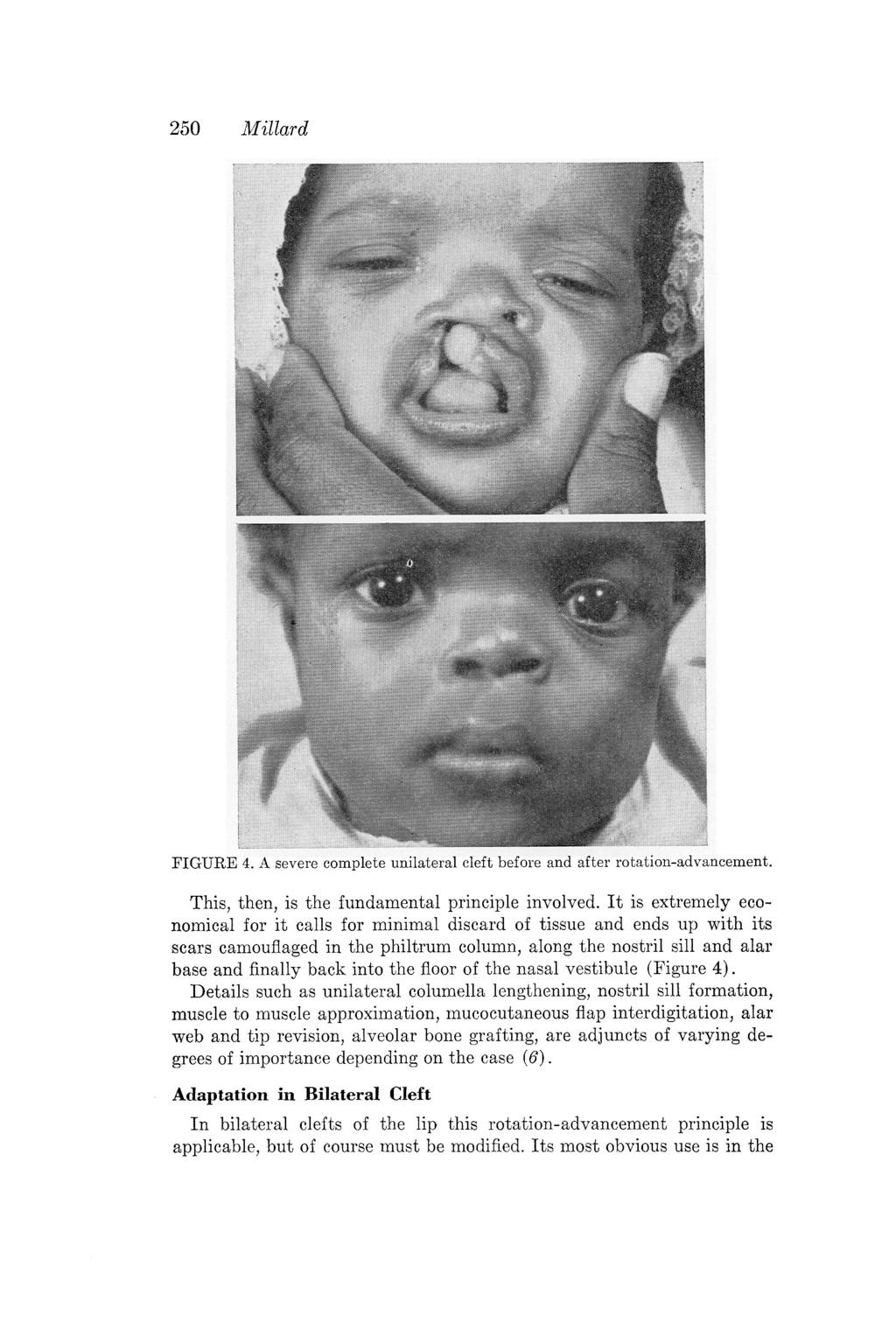 250 Millard FIGURE 4. A severe complete unilateral cleft before and after rotation-advancement. This, then, is the fundamental principle involved.
